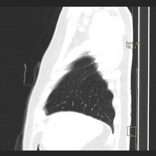 Classic complicated silicosis (Radiopaedia 49720-54961 Sagittal lung window 55).jpg