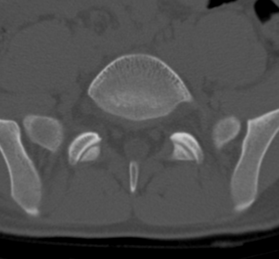 Clear cell meningoma - lumbar spine (Radiopaedia 60116-67691 Axial bone window 64).png