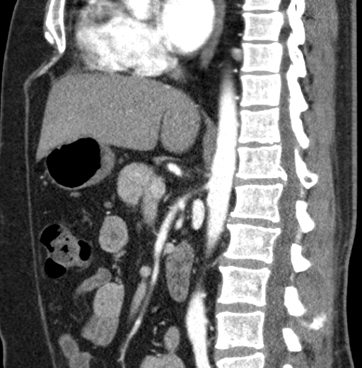 File:Clear cell renal cell carcinoma (Radiopaedia 61449-69393 D 56).jpg