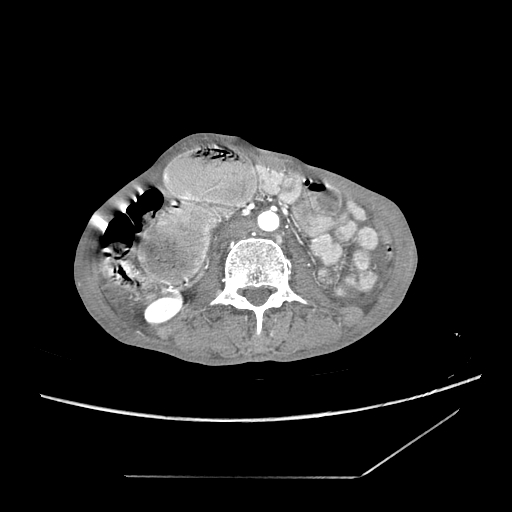 Closed-loop obstruction due to peritoneal seeding mimicking internal hernia after total gastrectomy (Radiopaedia 81897-95864 A 97).jpg