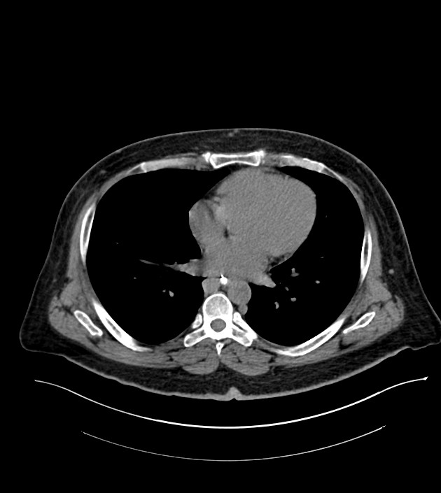 Closed-loop small bowel obstruction-internal hernia (Radiopaedia 78439-91096 Axial non-contrast 4).jpg