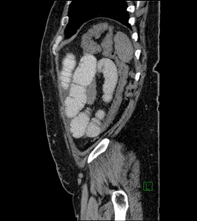 Closed-loop small bowel obstruction-internal hernia (Radiopaedia 78439-91096 C 31).jpg