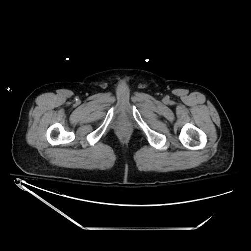File:Closed loop obstruction due to adhesive band, resulting in small bowel ischemia and resection (Radiopaedia 83835-99023 Axial 132).jpg