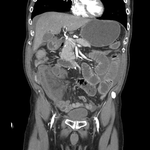 File:Closed loop obstruction due to adhesive band, resulting in small bowel ischemia and resection (Radiopaedia 83835-99023 C 50).jpg