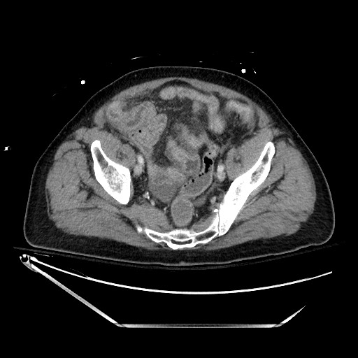 File:Closed loop obstruction due to adhesive band, resulting in small bowel ischemia and resection (Radiopaedia 83835-99023 D 128).jpg