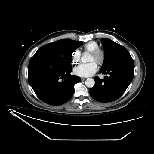 File:Closed loop obstruction due to adhesive band, resulting in small bowel ischemia and resection (Radiopaedia 83835-99023 D 2).jpg
