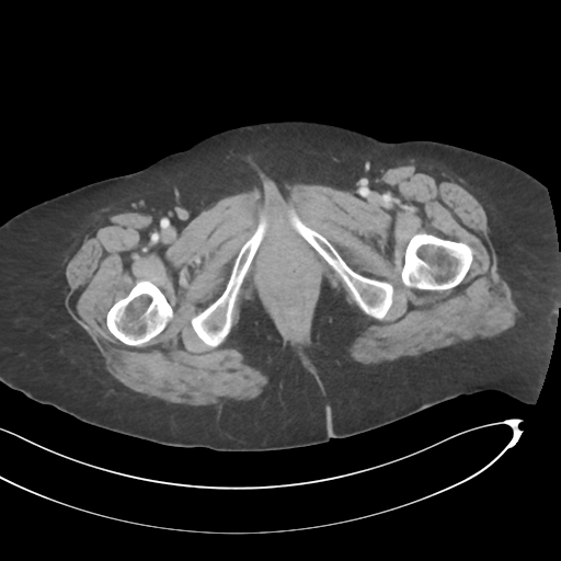 Closed loop small bowel obstruction (Radiopaedia 58281-65391 A 91).png