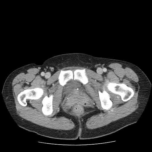 File:Closed loop small bowel obstruction (Radiopaedia 65403-74451 Axial 66).jpg
