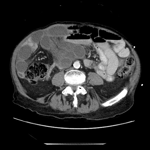Closed loop small bowel obstruction - adhesive disease and hemorrhagic ischemia (Radiopaedia 86831-102990 A 113).jpg