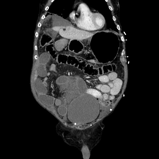 Closed loop small bowel obstruction - adhesive disease and hemorrhagic ischemia (Radiopaedia 86831-102990 B 41).jpg