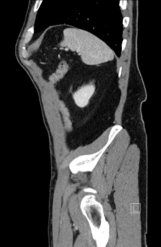 Closed loop small bowel obstruction - internal hernia (Radiopaedia 57806-64778 C 22).jpg