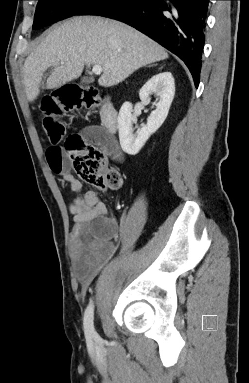 Closed loop small bowel obstruction - internal hernia (Radiopaedia 57806-64778 C 78).jpg