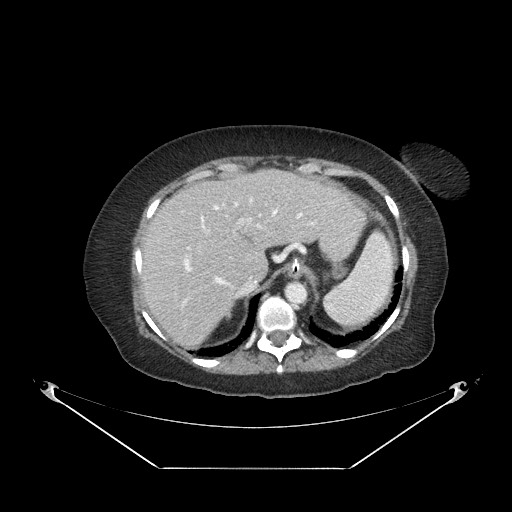 Closed loop small bowel obstruction - internal hernia (Radiopaedia 65402-74450 A 17).jpg