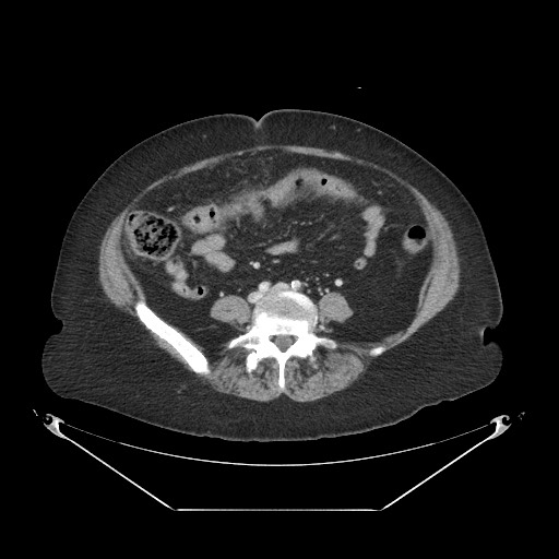 Closed loop small bowel obstruction - internal hernia (Radiopaedia 65402-74450 A 82).jpg