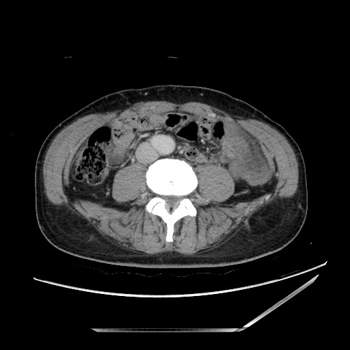 Closed loop small bowel obstruction - omental adhesion causing "internal hernia" (Radiopaedia 85129-100682 A 100).jpg