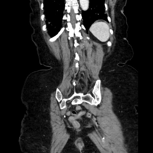 Closed loop small bowel obstruction due to adhesive band, with intramural hemorrhage and ischemia (Radiopaedia 83831-99017 C 103).jpg