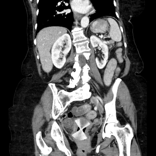 Closed loop small bowel obstruction due to adhesive band, with intramural hemorrhage and ischemia (Radiopaedia 83831-99017 C 81).jpg