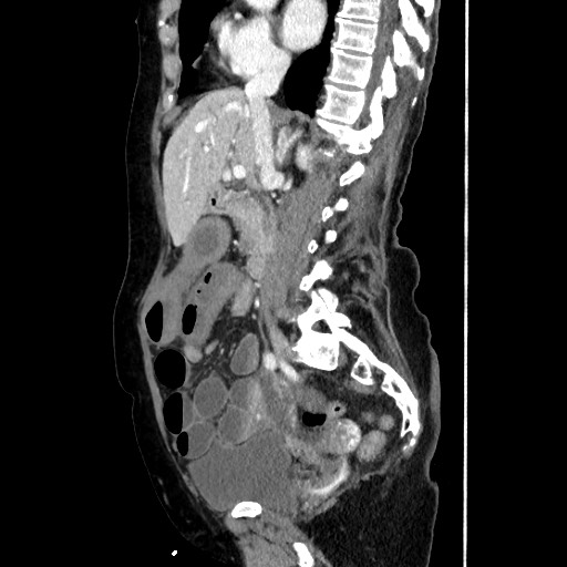 Closed loop small bowel obstruction due to adhesive band, with intramural hemorrhage and ischemia (Radiopaedia 83831-99017 D 92).jpg