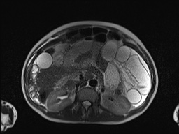 File:Closed loop small bowel obstruction in pregnancy (MRI) (Radiopaedia 87637-104031 Axial T2 28).jpg