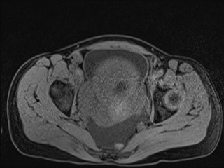 Closed loop small bowel obstruction in pregnancy (MRI) (Radiopaedia 87637-104031 F 57).jpg