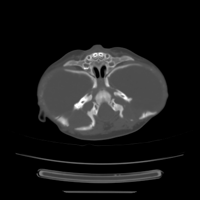 Cloverleaf skull (Radiopaedia 91901-109710 Axial bone window 49).jpg