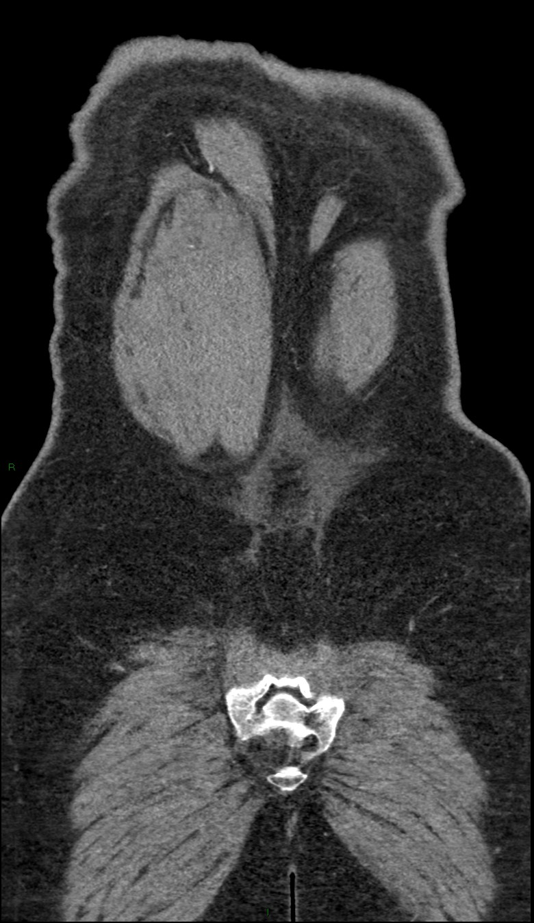 Coarctation of the aorta (Radiopaedia 74632-88521 B 250).jpg