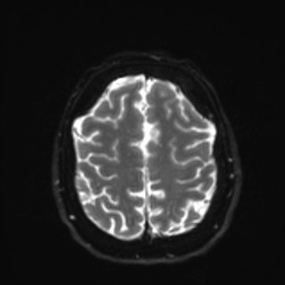 Cochlear incomplete partition type III associated with hypothalamic hamartoma (Radiopaedia 88756-105498 Axial DWI 33).jpg