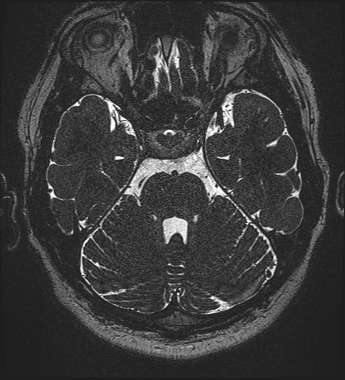 Cochlear incomplete partition type III associated with hypothalamic hamartoma (Radiopaedia 88756-105498 Axial T2 110).jpg