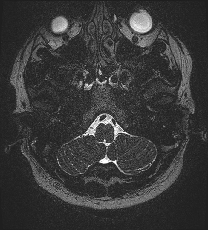 Cochlear incomplete partition type III associated with hypothalamic hamartoma (Radiopaedia 88756-105498 Axial T2 28).jpg