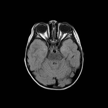 File:Cochlear nerve aplasia - unilateral (Radiopaedia 87910-104413 Axial FLAIR 11).jpg