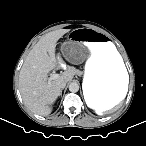 Colocolic intussusception due to large lipoma (Radiopaedia 68773-78482 A 36).jpg