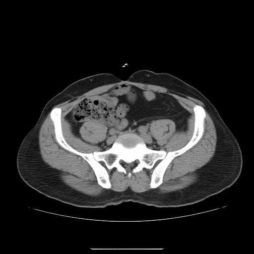 File:Colocutaneous fistula in Crohn's disease (Radiopaedia 29586-30093 Axial non-contrast 26).jpg