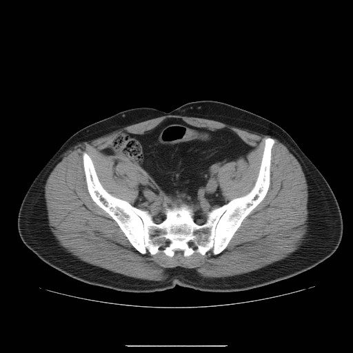 File:Colocutaneous fistula in Crohn's disease (Radiopaedia 29586-30093 Axial non-contrast 31).jpg
