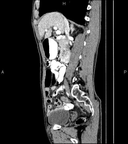 Colon adenocarcinoma - hepatic flexure (Radiopaedia 85635-101395 D 34).jpg