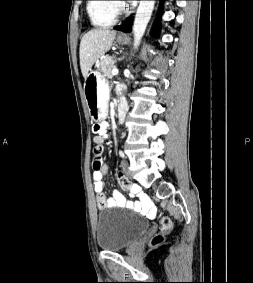 Colon adenocarcinoma - hepatic flexure (Radiopaedia 85635-101395 D 52).jpg