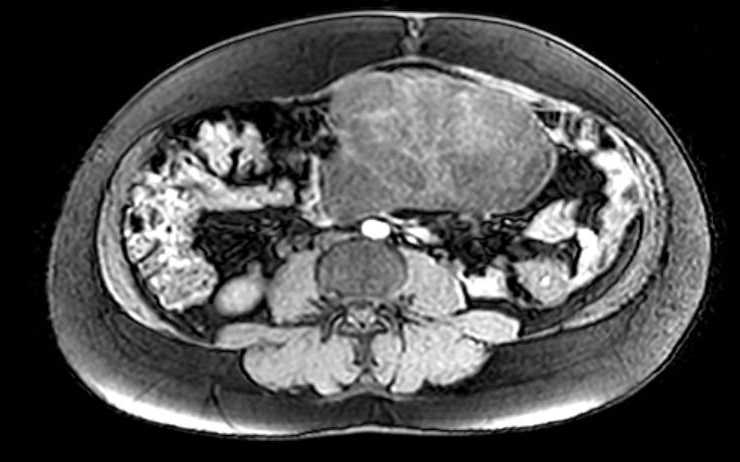 Colon adenocarcinoma with Krukenberg tumors, advanced pregnancy (Radiopaedia 67279-76645 A 41).jpg