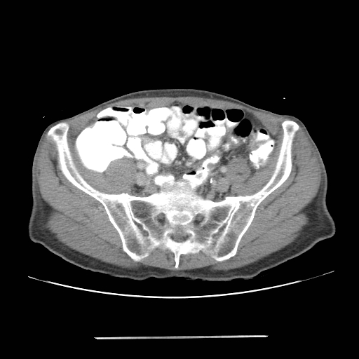 File:Colon cancer with calcified liver metastasis (Radiopaedia 74423-85307 A 58).jpg