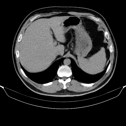 File:Colonic lipoma with colo-colic intussusception (Radiopaedia 58944-66200 Axial C+ rectal 6).jpg