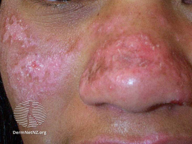 Cutaneous lupus erythematosus (DermNet NZ immune-lupus-erythematosus-2549).jpg