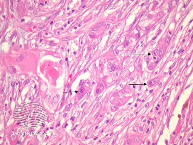 File:Figure 5 (DermNet NZ pathology-e-proliferating-trichilemmal-cyst-fig-5).jpg