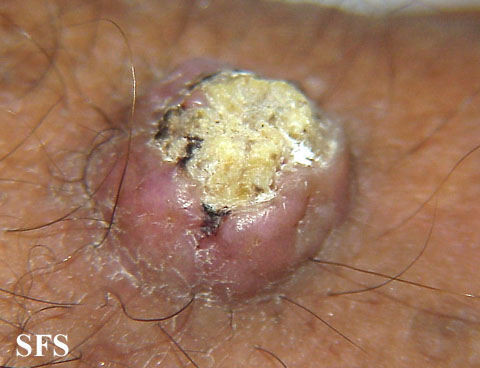 File:Keratoacanthoma (Dermatology Atlas 27).jpg