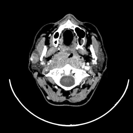 File:Nasopharyngeal carcinoma - infiltrating the clivus (Radiopaedia 62583-70875 Axial Post contrast 22).jpg
