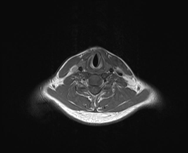 File:Nasopharyngeal carcinoma with perineural spread (Radiopaedia 55030-61380 Axial T1 8).jpg
