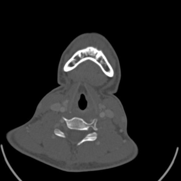 Nasopharyngeal carcinoma with skull base invasion (Radiopaedia 53415-59705 Axial bone window 147).jpg