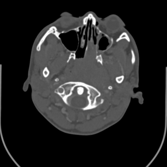 Nasopharyngeal carcinoma with skull base invasion (Radiopaedia 53415-59705 Axial bone window 42).jpg