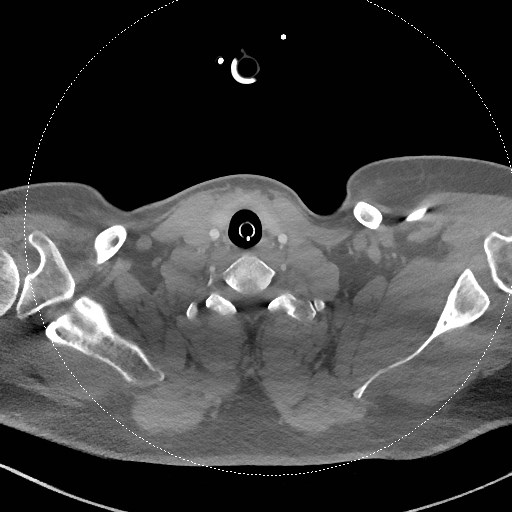 Neck CT angiogram (intraosseous vascular access) (Radiopaedia 55481-61945 B 125).jpg