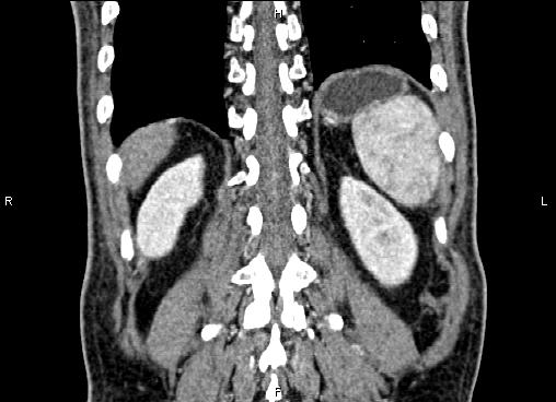 Necrotizing pancreatitis (Radiopaedia 87796-104248 F 56).jpg