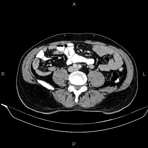 Necrotizing pancreatitis (Radiopaedia 87796-104249 A 36).jpg