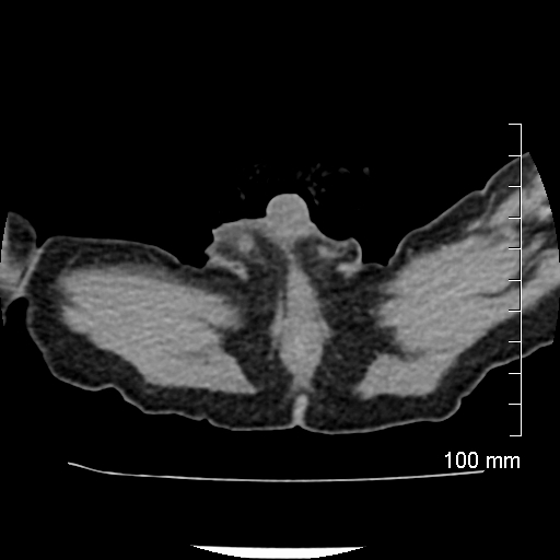 File:Neonatal neuroblastoma (Radiopaedia 56651-63438 Axial non-contrast 91).jpg
