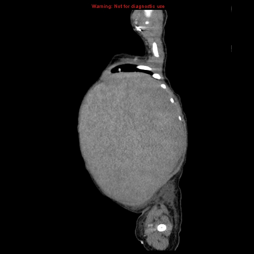 File:Neonatal neuroblastoma (Radiopaedia 9564-10223 C 25).jpg